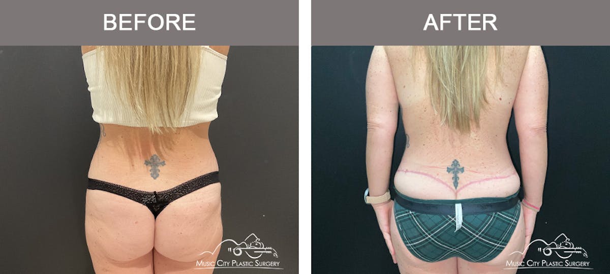 Belt Lipectomy Before & After Gallery - Patient 227605 - Image 4
