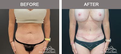Belt Lipectomy Before & After Gallery - Patient 227605 - Image 1