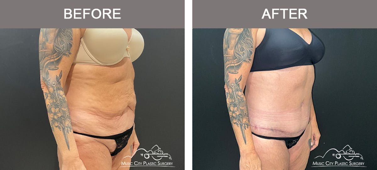 Belt Lipectomy Before & After Gallery - Patient 260950 - Image 3