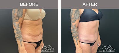Belt Lipectomy Before & After Gallery - Patient 260950 - Image 3