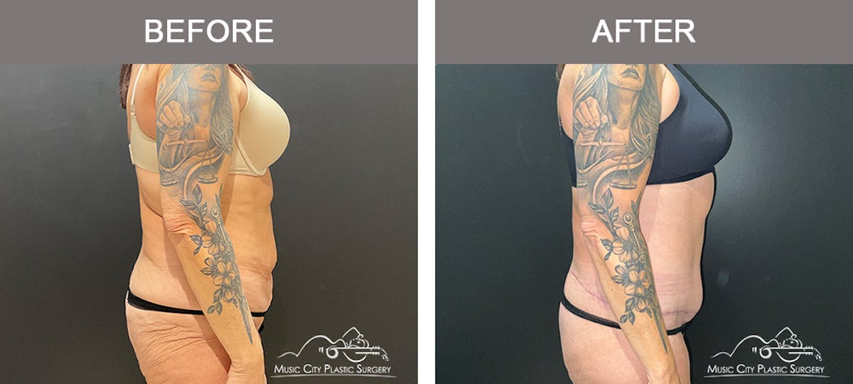 Belt Lipectomy Before & After Gallery - Patient 260950 - Image 4