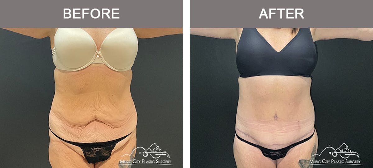 Belt Lipectomy Before & After Gallery - Patient 260950 - Image 2