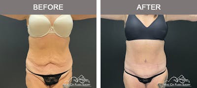 Belt Lipectomy Before & After Gallery - Patient 260950 - Image 2
