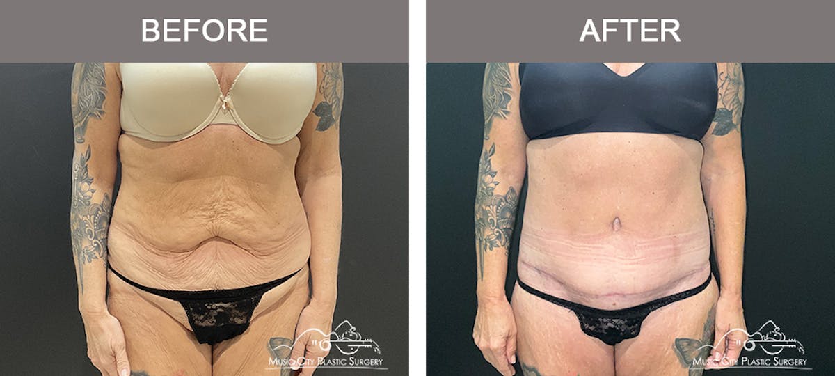 Belt Lipectomy Before & After Gallery - Patient 260950 - Image 1