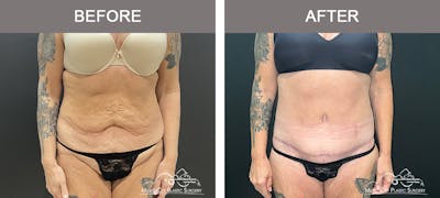 Belt Lipectomy Before & After Gallery - Patient 260950 - Image 1