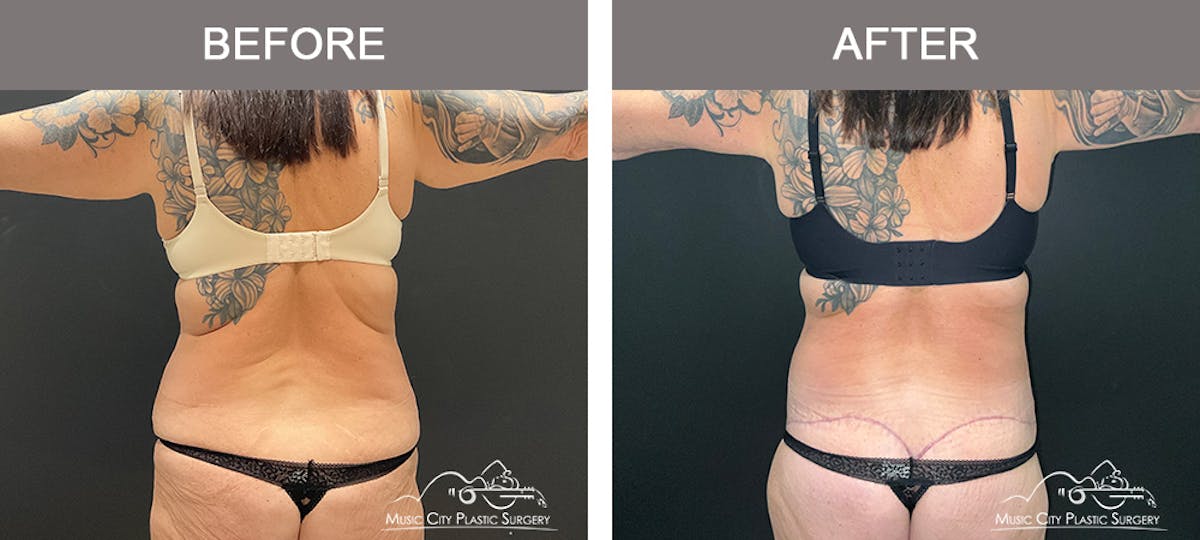 Belt Lipectomy Before & After Gallery - Patient 260950 - Image 5