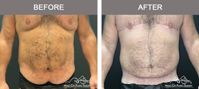 Male Lipectomy Before & After Gallery - Patient 336369 - Image 1