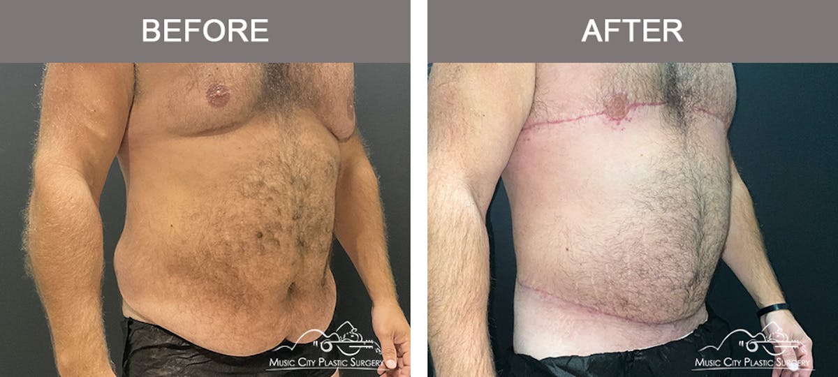 Male Lipectomy Before & After Gallery - Patient 336369 - Image 2