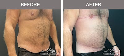 Male Lipectomy Before & After Gallery - Patient 336369 - Image 2