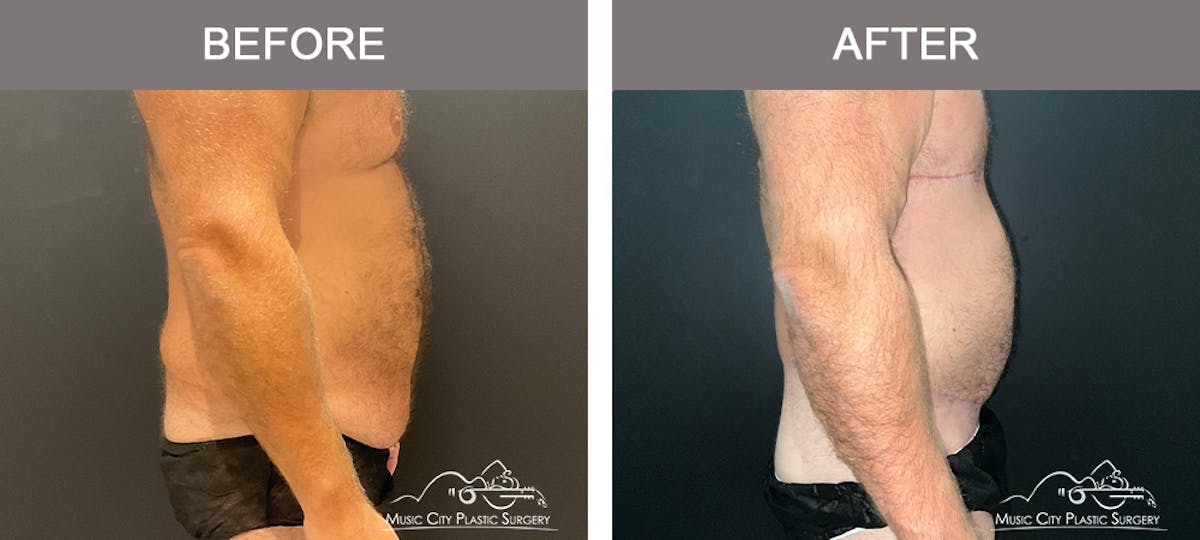 Male Lipectomy Before & After Gallery - Patient 336369 - Image 3