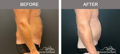 Male Lipectomy Before & After Gallery - Patient 336369 - Image 3