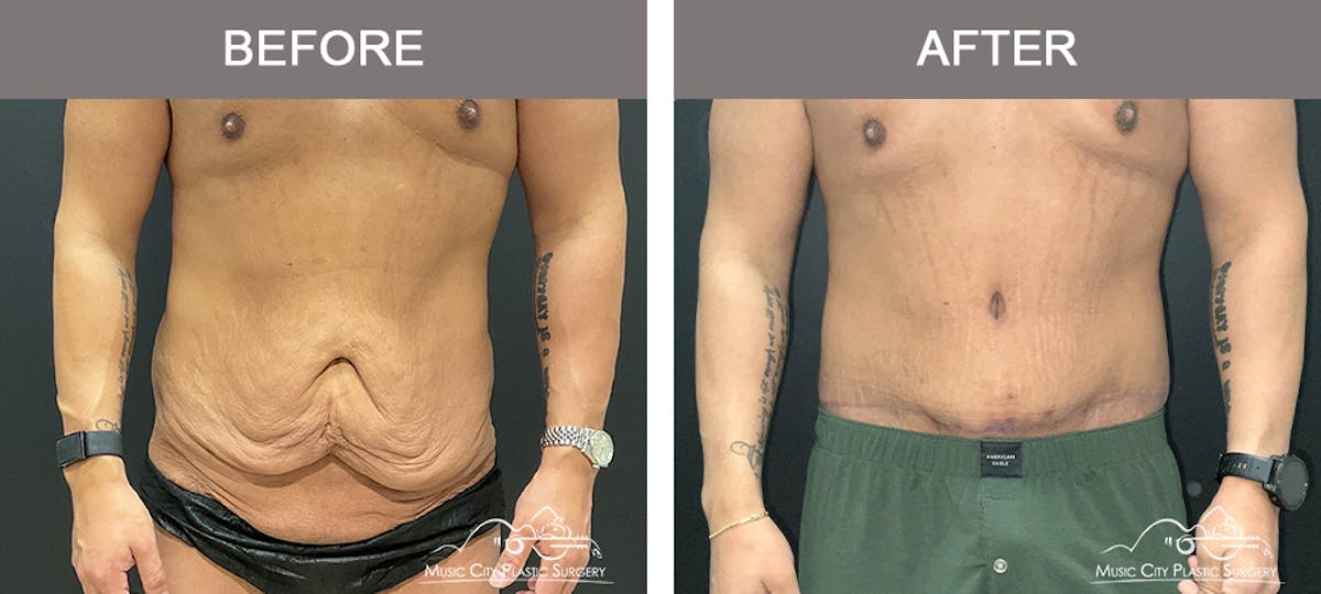 Male Lipectomy Before & After Gallery - Patient 385668 - Image 1