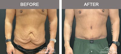 Male Lipectomy Before & After Gallery - Patient 385668 - Image 1