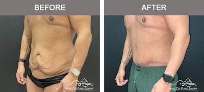 Male Lipectomy Before & After Gallery - Patient 385668 - Image 2