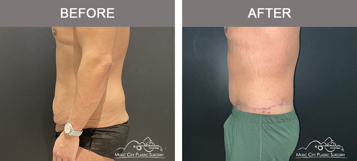 Male Lipectomy Before & After Gallery - Patient 385668 - Image 3