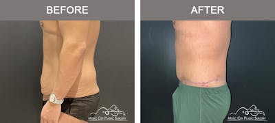Male Lipectomy Before & After Gallery - Patient 385668 - Image 3