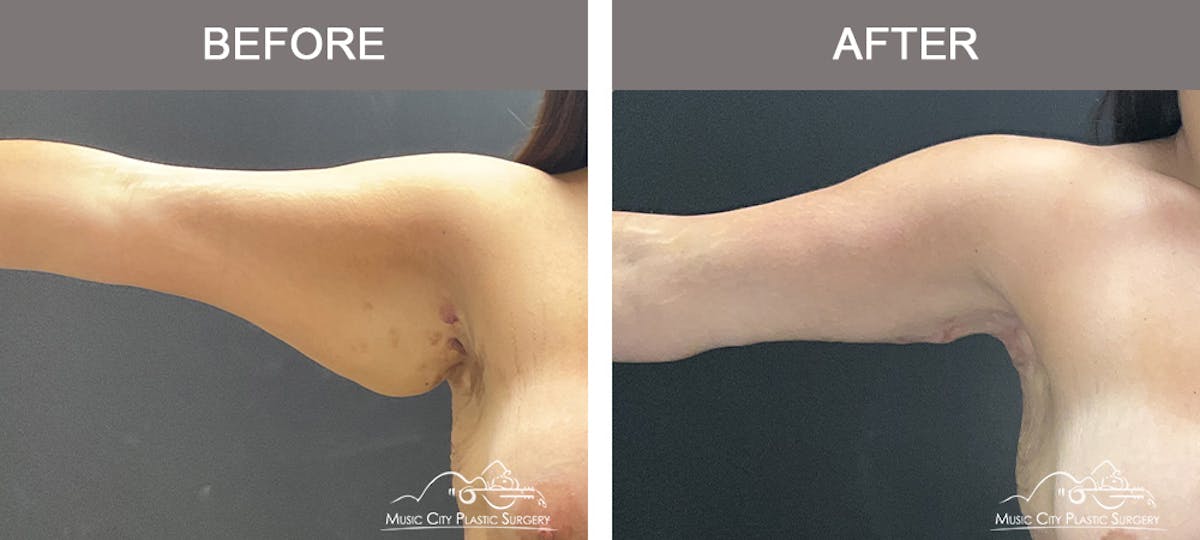 Arm Lift Before & After Gallery - Patient 389747 - Image 5