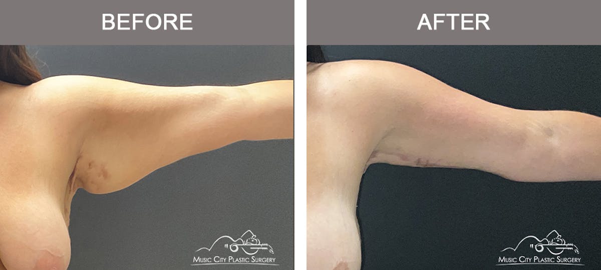 Arm Lift Before & After Gallery - Patient 389747 - Image 1