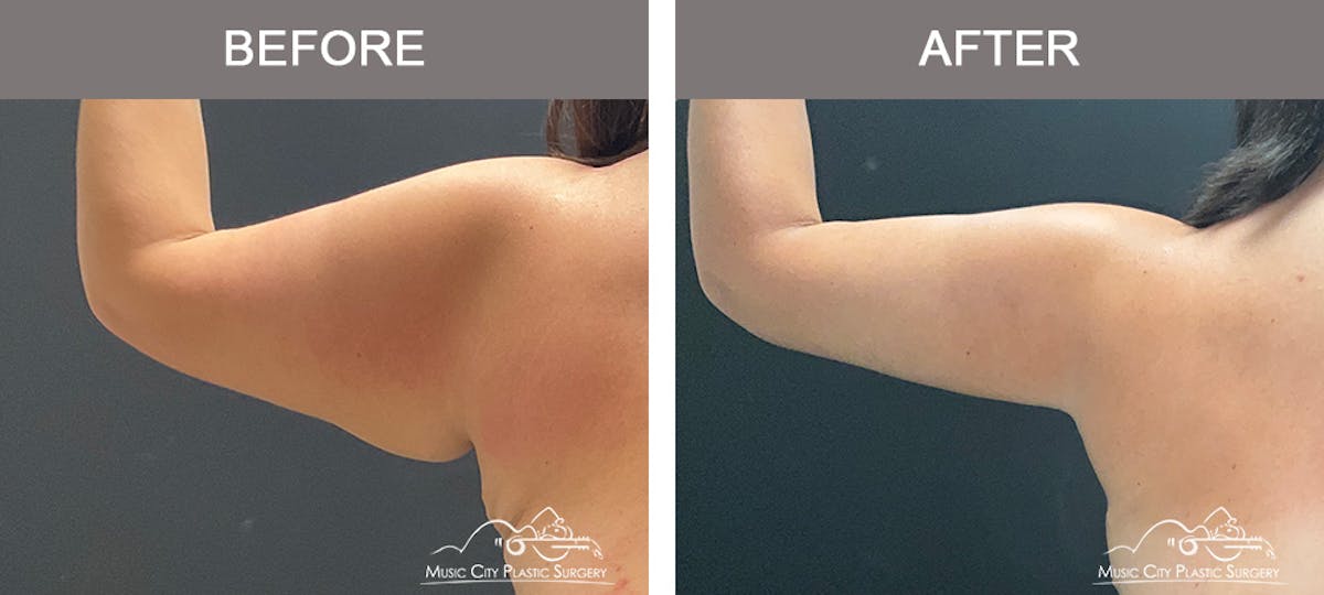 Arm Lift Before & After Gallery - Patient 389747 - Image 3