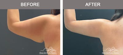 Arm Lift Before & After Gallery - Patient 389747 - Image 3