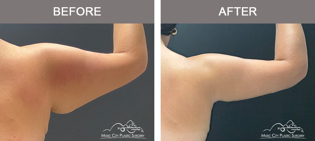 Arm Lift Before & After Gallery - Patient 389747 - Image 4