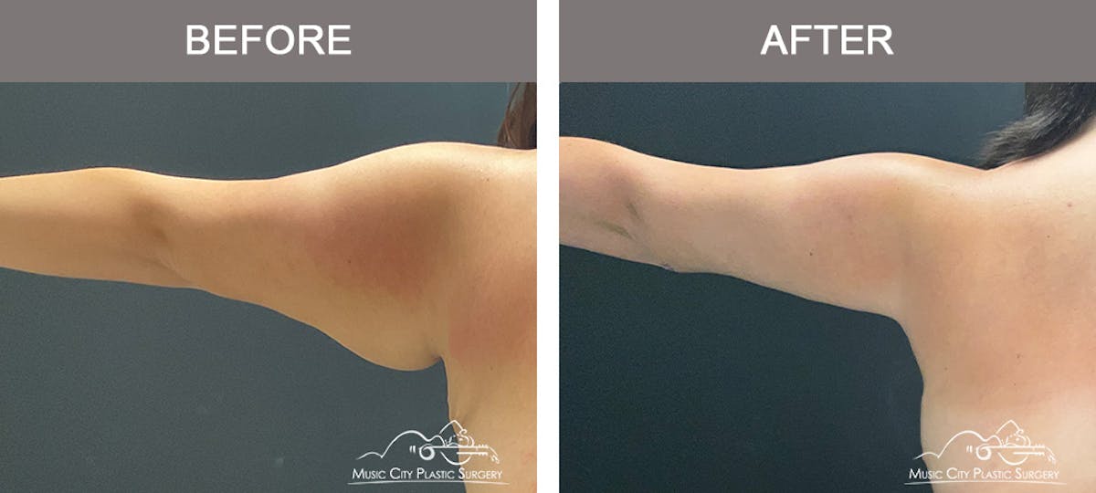 Arm Lift Before & After Gallery - Patient 389747 - Image 6