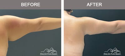 Arm Lift Before & After Gallery - Patient 389747 - Image 2