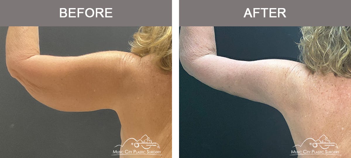 Arm Lift Before & After Gallery - Patient 394059 - Image 3