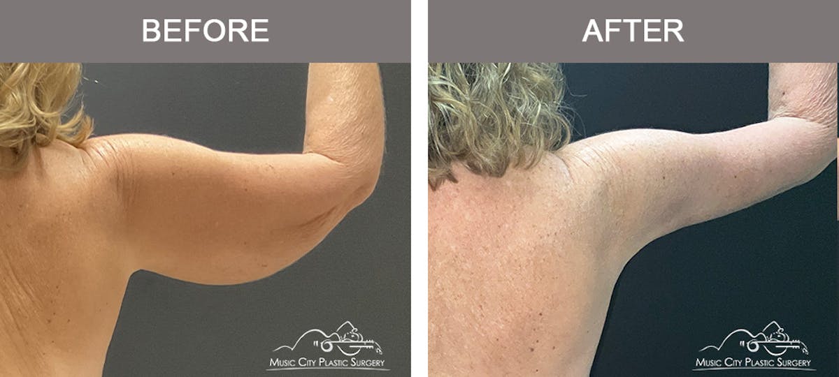 Arm Lift Before & After Gallery - Patient 394059 - Image 4