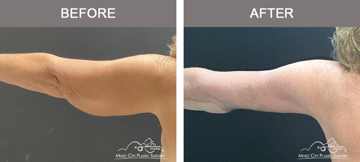 Arm Lift Before & After Gallery - Patient 394059 - Image 1
