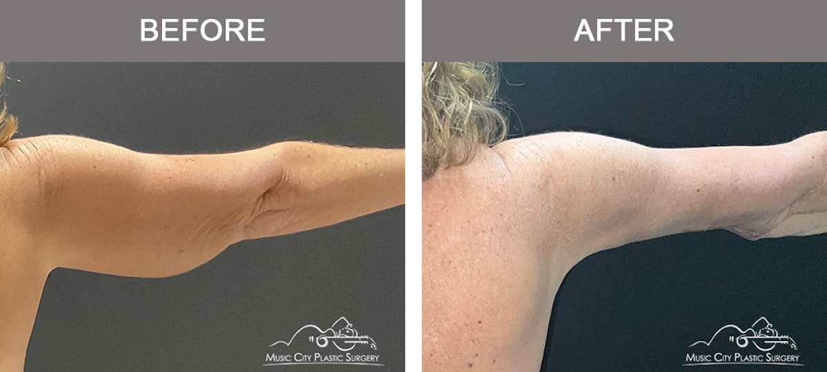 Arm Lift Before & After Gallery - Patient 394059 - Image 2