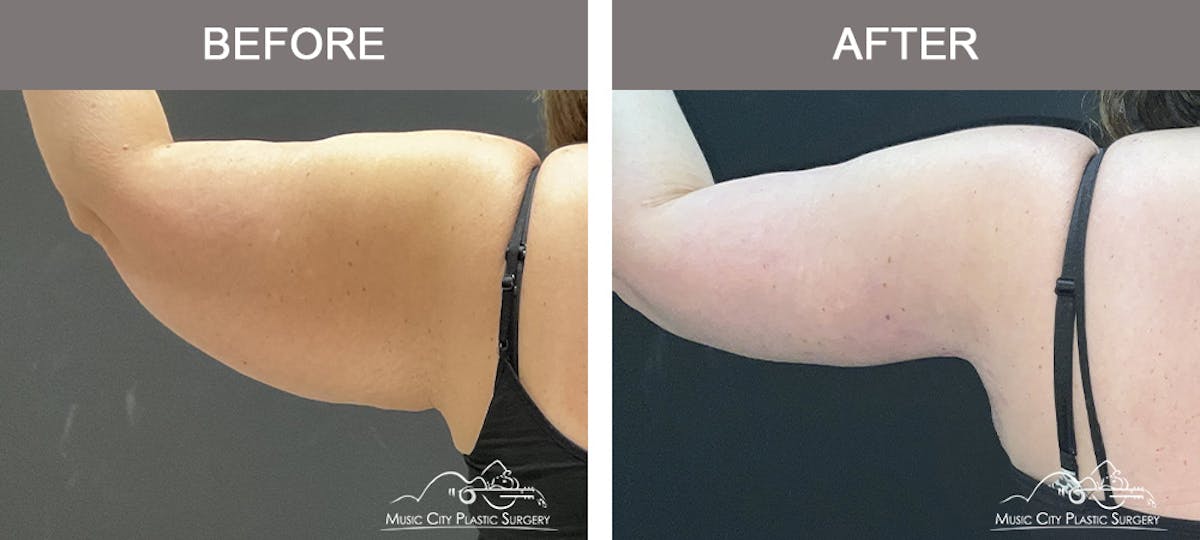 Arm Lift Before & After Gallery - Patient 123473 - Image 3