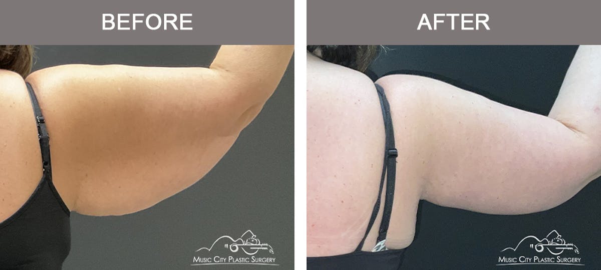 Arm Lift Before & After Gallery - Patient 123473 - Image 4