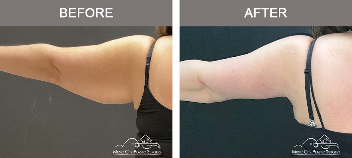 Arm Lift Before & After Gallery - Patient 123473 - Image 1