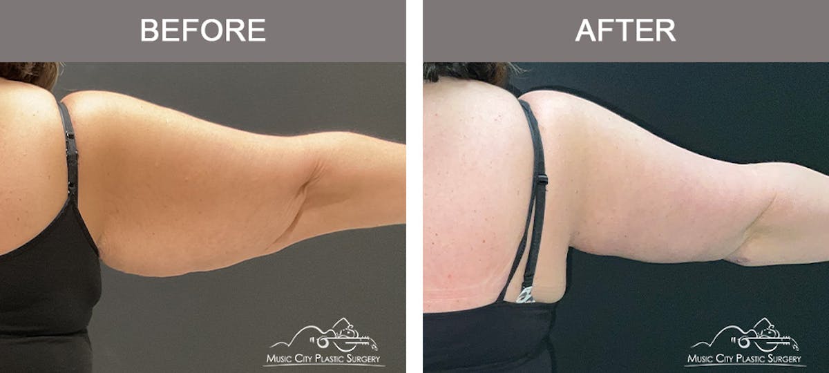 Arm Lift Before & After Gallery - Patient 123473 - Image 2