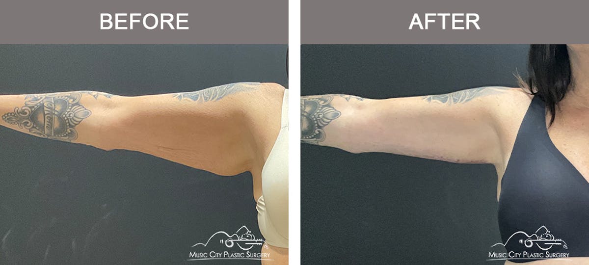 Arm Lift Before & After Gallery - Patient 123300 - Image 1