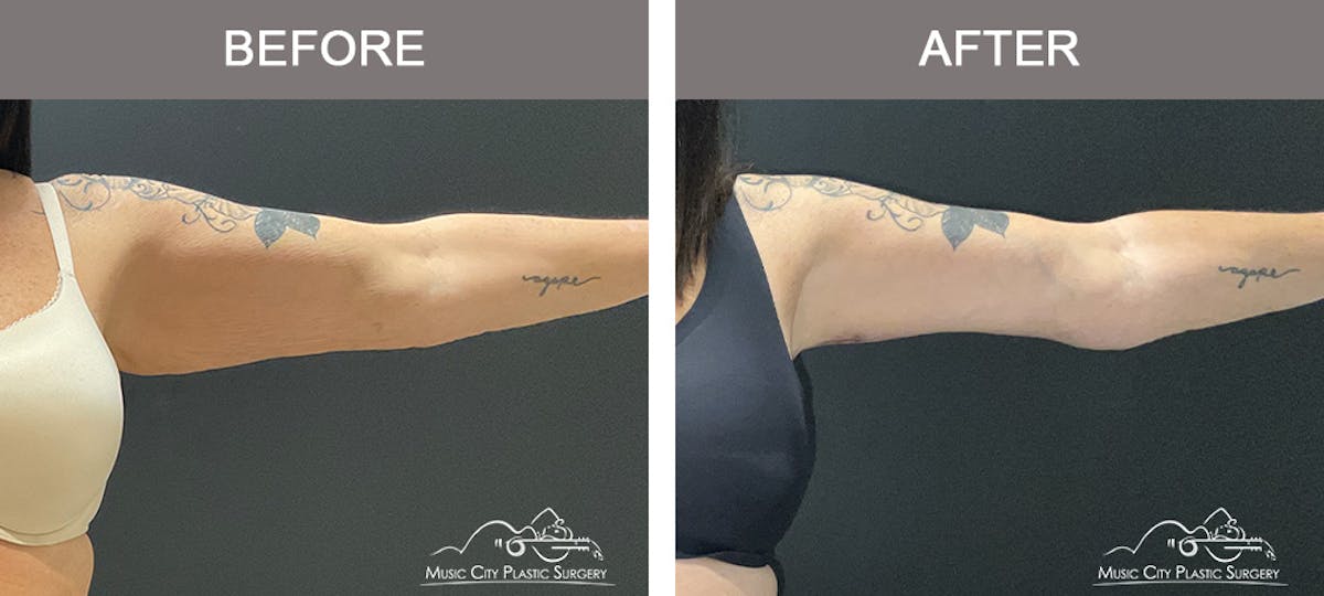 Arm Lift Before & After Gallery - Patient 123300 - Image 2