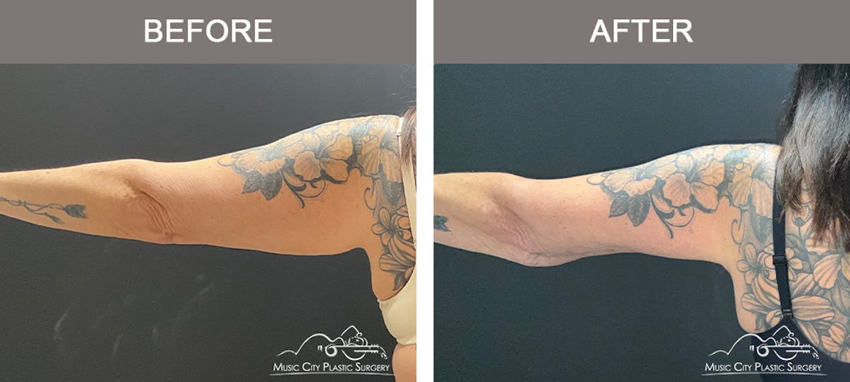 Arm Lift Before & After Gallery - Patient 123300 - Image 3