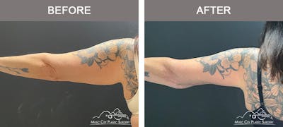 Arm Lift Before & After Gallery - Patient 123300 - Image 3