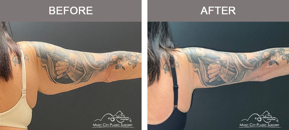 Arm Lift Before & After Gallery - Patient 123300 - Image 4