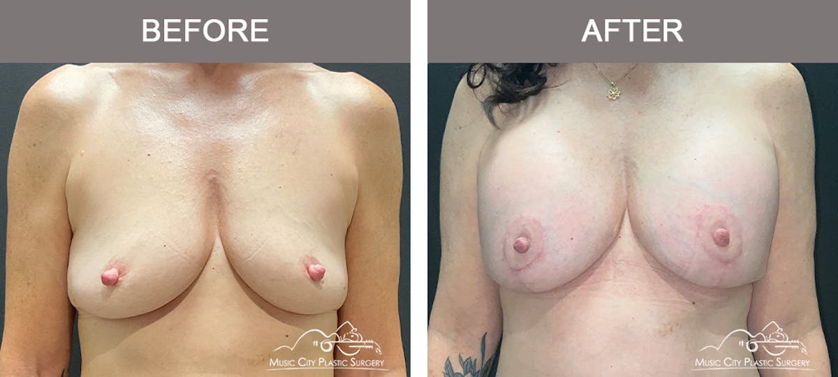 Breast Augmentation Before & After Gallery - Patient 153727 - Image 1