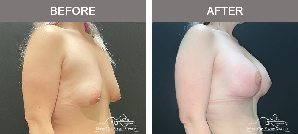 Breast Augmentation Before & After Gallery - Patient 241959 - Image 2