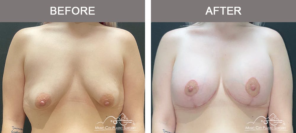 Breast Augmentation Before & After Gallery - Patient 241959 - Image 1