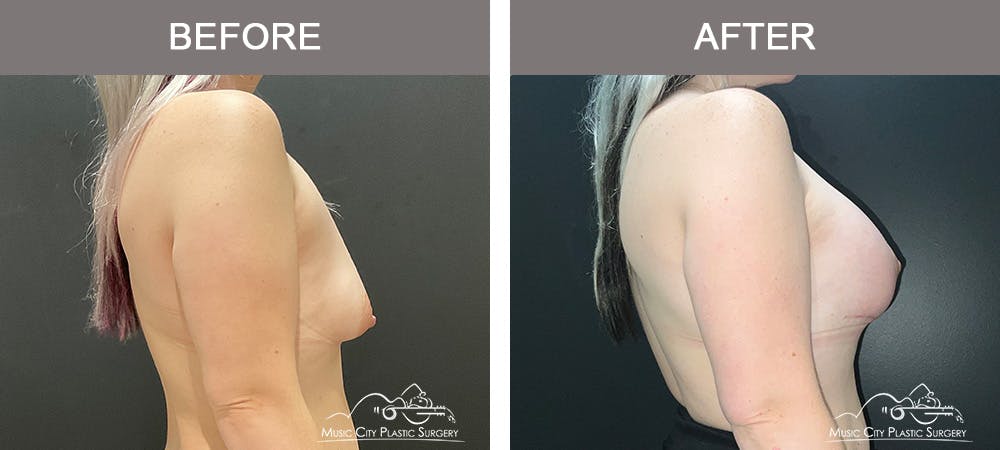 Breast Augmentation Before & After Gallery - Patient 241959 - Image 3
