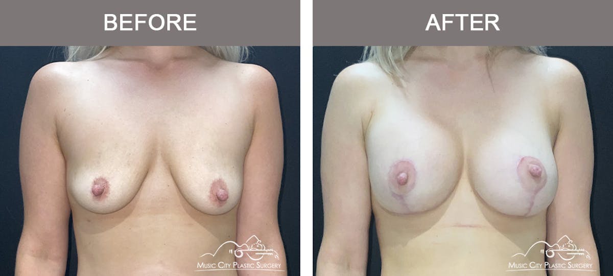 Breast Augmentation Before & After Gallery - Patient 488080 - Image 1
