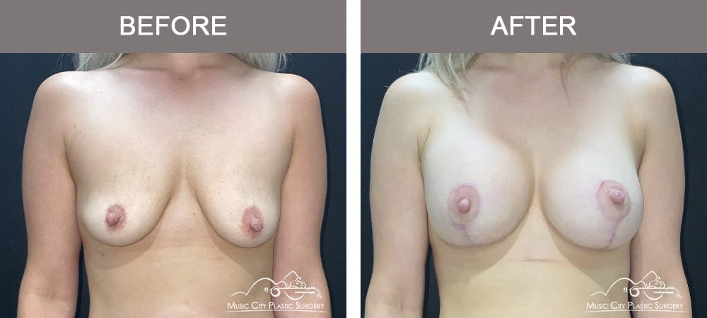 Breast Lift Before & After Gallery - Patient 184326 - Image 1