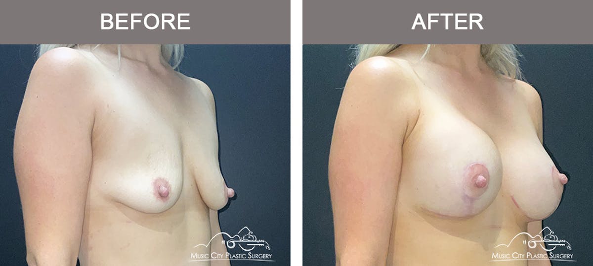 Breast Augmentation Before & After Gallery - Patient 488080 - Image 2