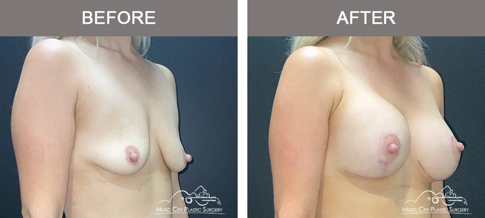 Breast Lift Before & After Gallery - Patient 184326 - Image 2