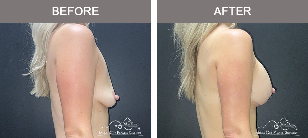Breast Lift Before & After Gallery - Patient 184326 - Image 3