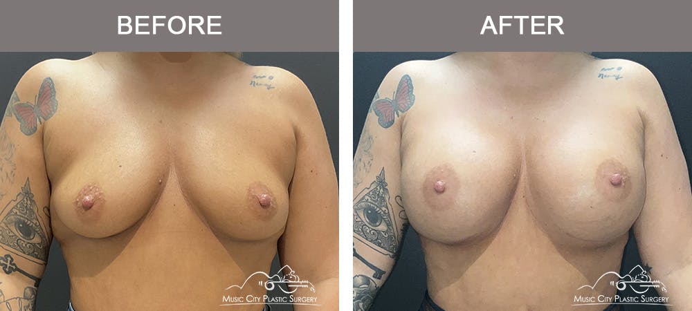 Breast Augmentation Before & After Gallery - Patient 346921 - Image 1